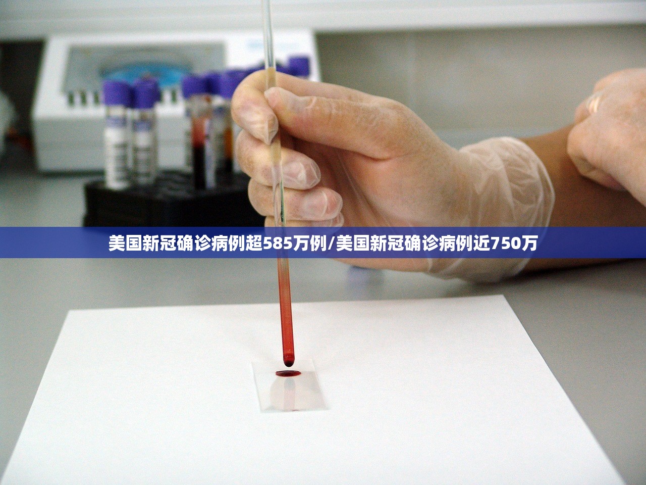 美国新冠确诊病例超585万例/美国新冠确诊病例近750万
